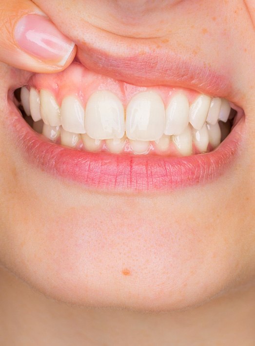 Woman pointing to her gums