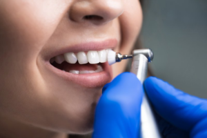 Close up of dentist polishing off a patient’s dental crown